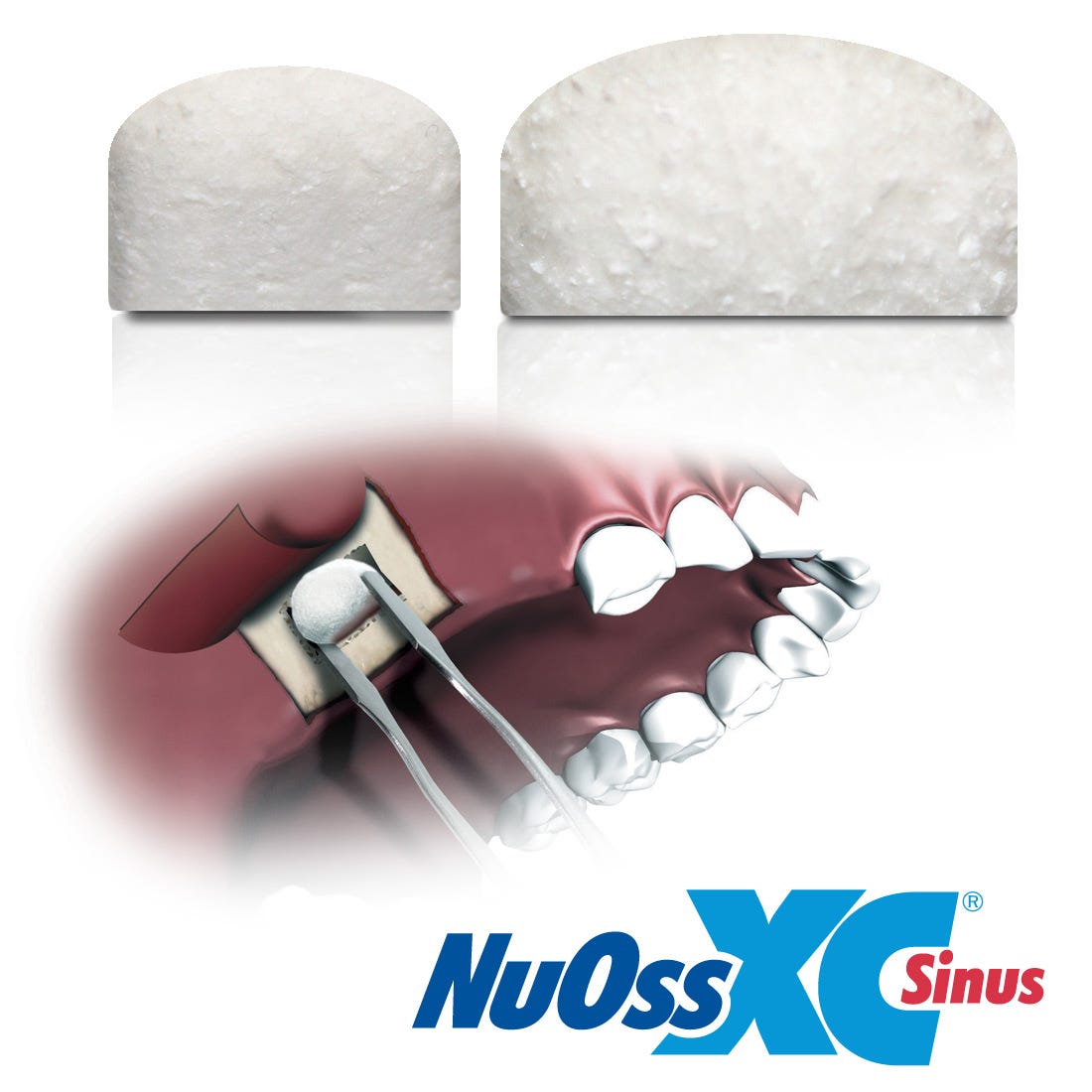 NuOss® XC Sinus - 22 x 12mm