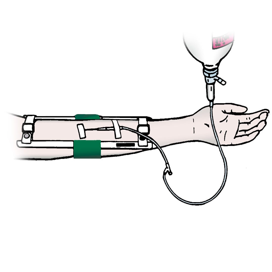 Adult Elbow Immobilizer -  11"