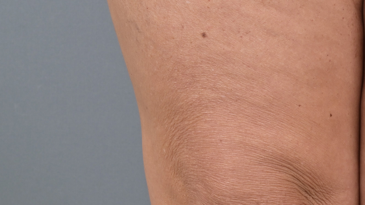 Immagine dopo il trattamento