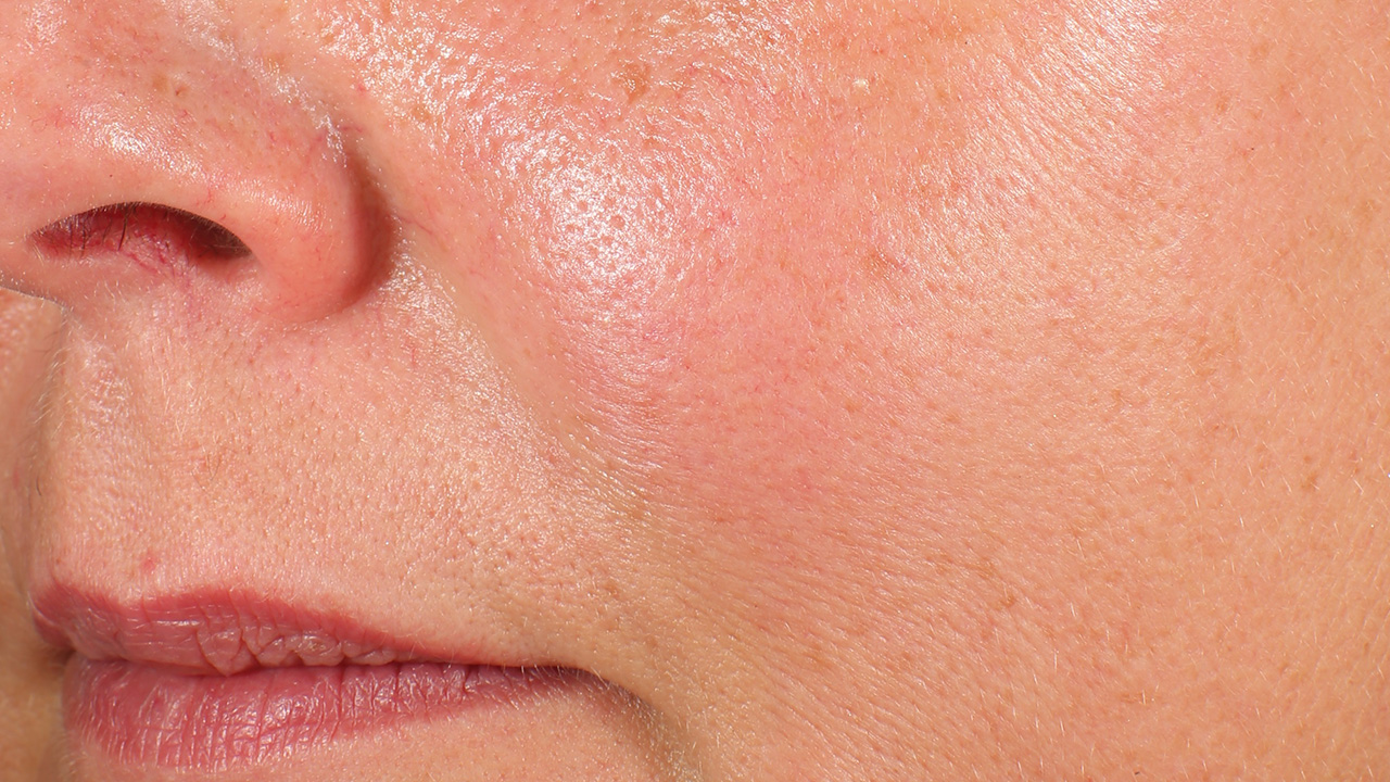 Afbeelding voor behandeling