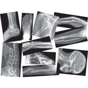 Broken Bones X-Ray Set, Pack of 15