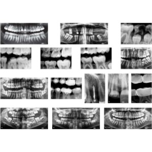 Dental X-Rays