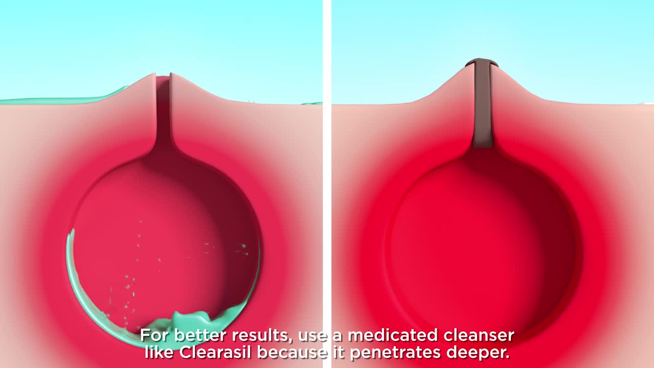 thumbnail video image 2 of Clearasil Rapid Rescue Deep Treatment Wash, Normal to Oily Skin, 6.78 fl oz, 2 of 12